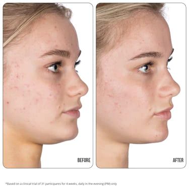 نيب + فاب جل ريتينول فيكس 10٪ لعلاج التصبغات - 15مل