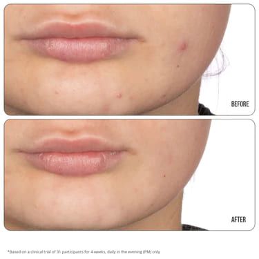 نيب + فاب جل ريتينول فيكس 10٪ لعلاج التصبغات - 15مل